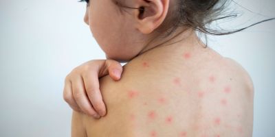 OMS en alerta por aumento de casos de sarampión, Minsa prepara vacunación masiva