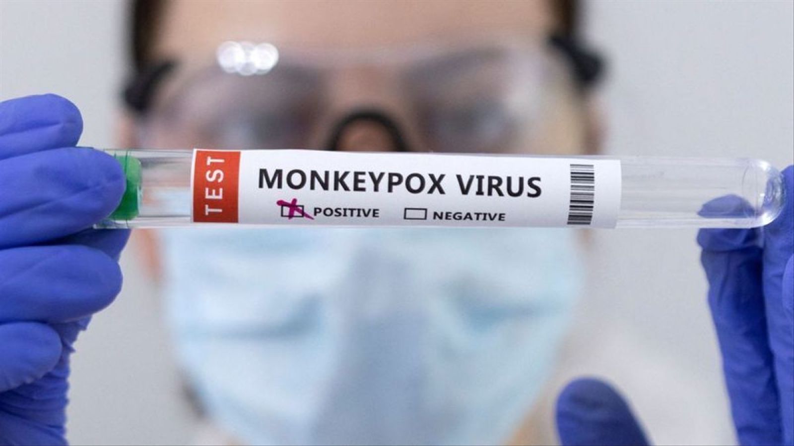 Minsa confirma 11 nuevos casos de viruela símica